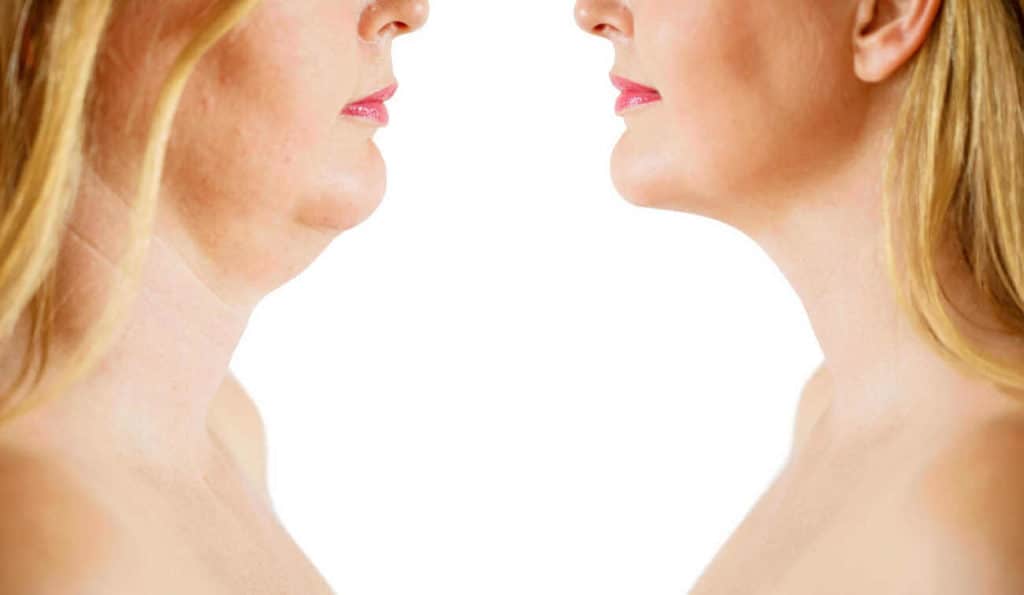 Double Chin treatment Stowmarket before and after results