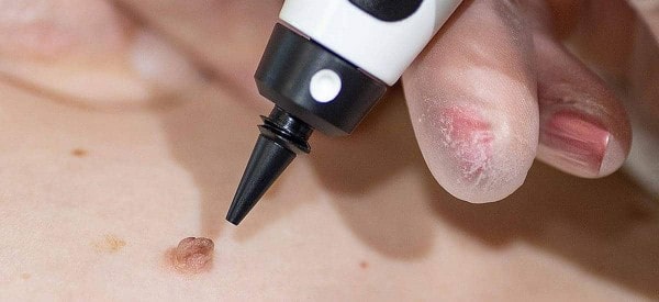 After Skin Tag Removal Stowmarket