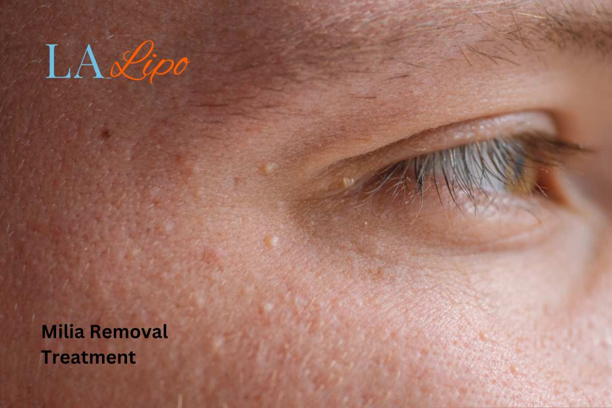 Cryopen Milia Removal: Is It the Easiest and Safest Option Stowmarket?