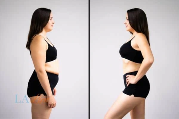 image of woman before and after results of LA-EMS Body Sculpting Stowmarket to help treat Diastasis recti