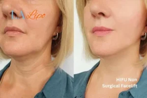 hi-fu for wrinkles Stowmarket before and after results