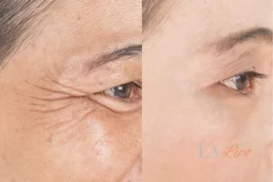 Before and after results of woman - HI-fu wrinkles reduction treatment Stowmarket