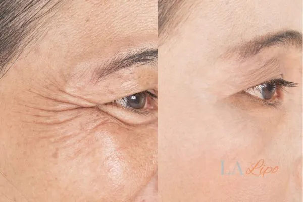 Before and after results of woman - HI-fu wrinkles reduction treatment Stowmarket