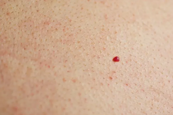 close up of a cherry angioma Stowmarket