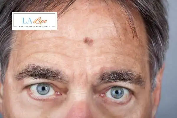 Solar Lentigo Removal Stowmarket image of man with mark on his forehead