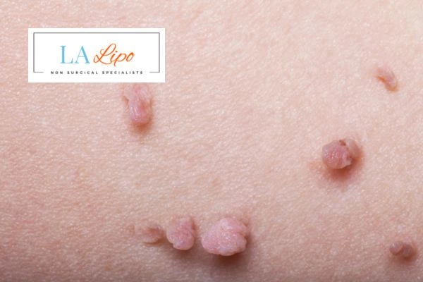 Does cryopen skin tag removal Stowmarket hurt? Find out now call our team today!