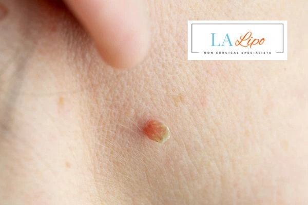 Book skin tag removal Stowmarket today speak to our team now!
