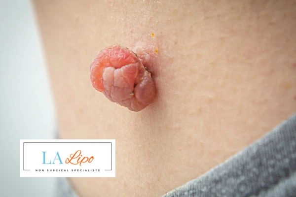 Interested in skin tag removal Stowmarket? Concerned about the pain? Find out more today!