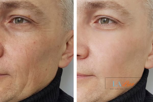 See the amazing results of Morpheus8 Treatment Stowmarket!