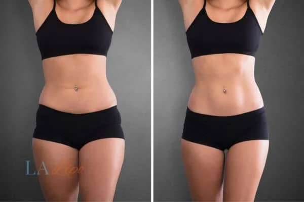 before and after results of non-surgical treatment to help a woman's body image and mental health Stowmarket