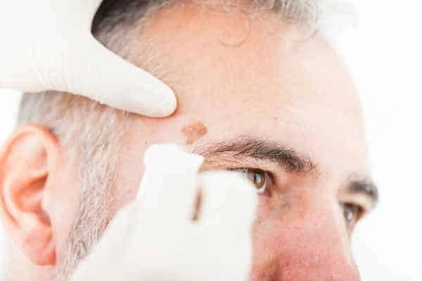 Age spots and elderly people Stowmarket what is the link?