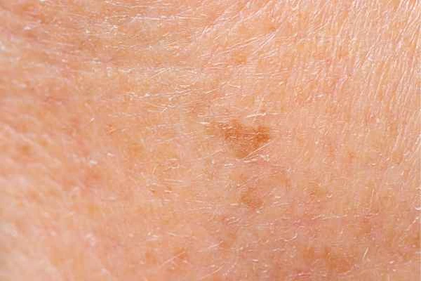 close up picture of age spots Stowmarket